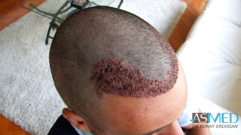 NORWOOD2 1800-grafts-FUE-2 b09e4796
