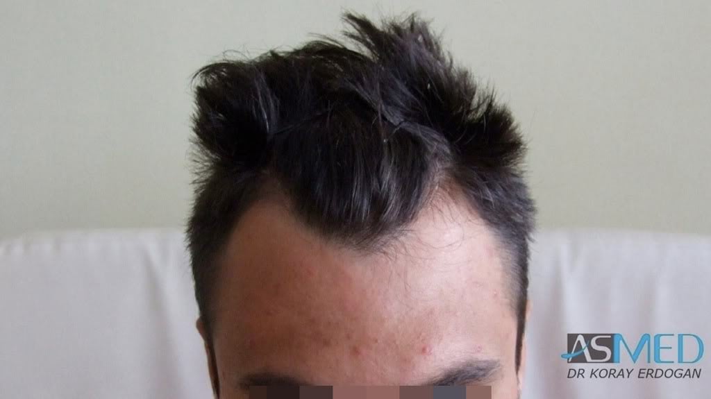 NORWOOD2 1800-grafts-FUE-2 c0cdeae3