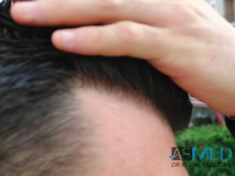 NORWOOD2 1800-grafts-FUE-2 c38da0b2