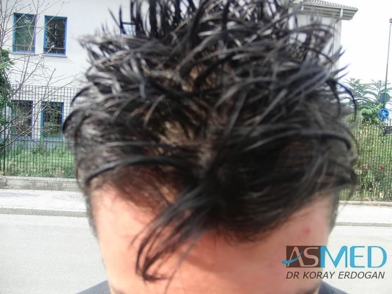 NORWOOD2 1800-grafts-FUE-2 d5ddf1f3