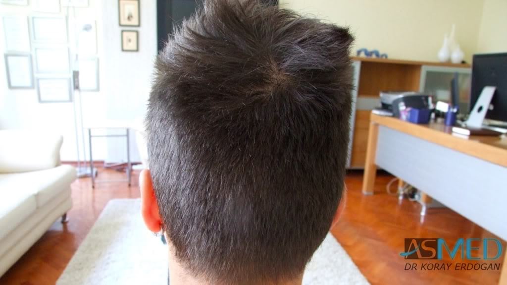 NORWOOD2 1800-grafts-FUE-2 eeaf493a