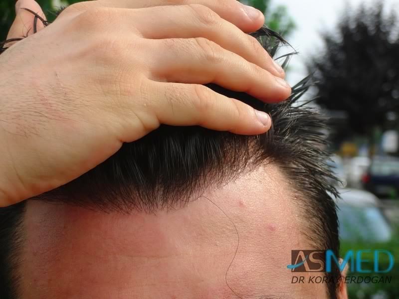 NORWOOD2 1800-grafts-FUE-2 f3a039c9