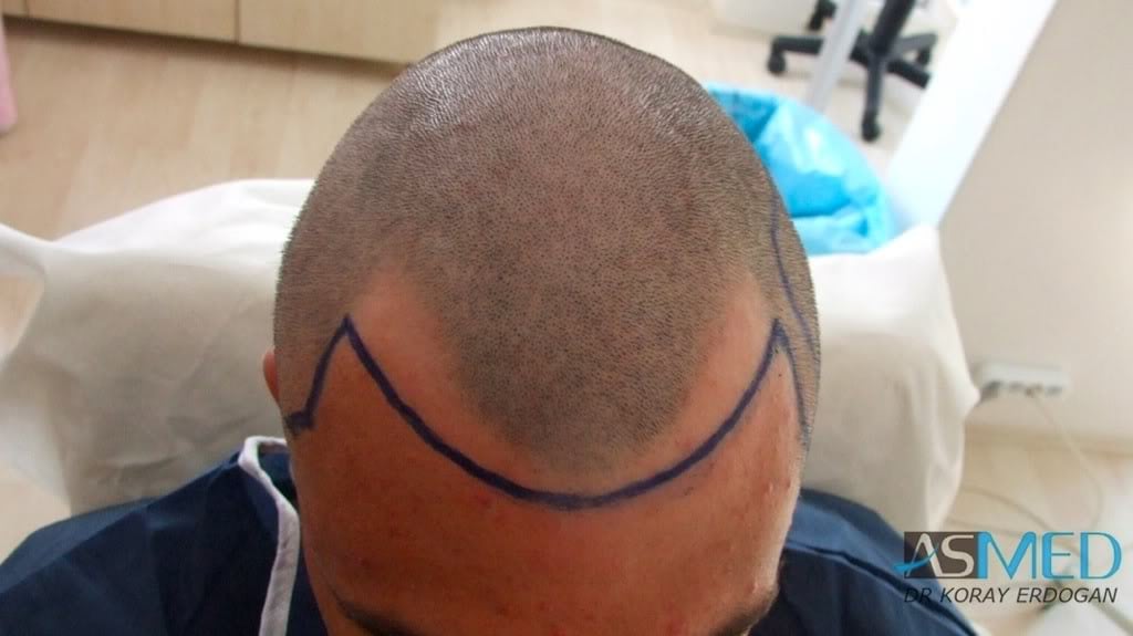 NORWOOD2 1800-grafts-FUE-2 fd88bf9b