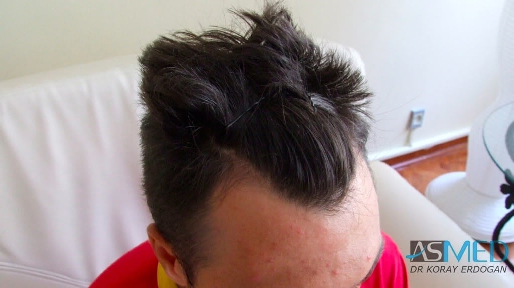 NORWOOD2 1800-grafts-FUE-2 fe1c63b0