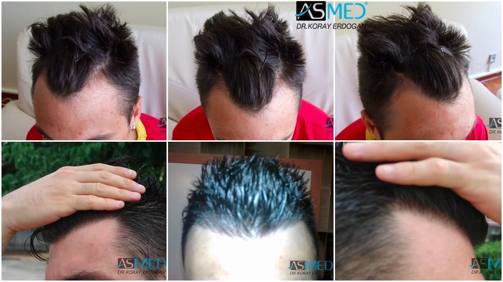 1800-grafts-FUE-2