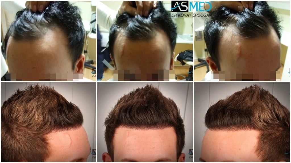 1800-grafts-FUE-3 gallery