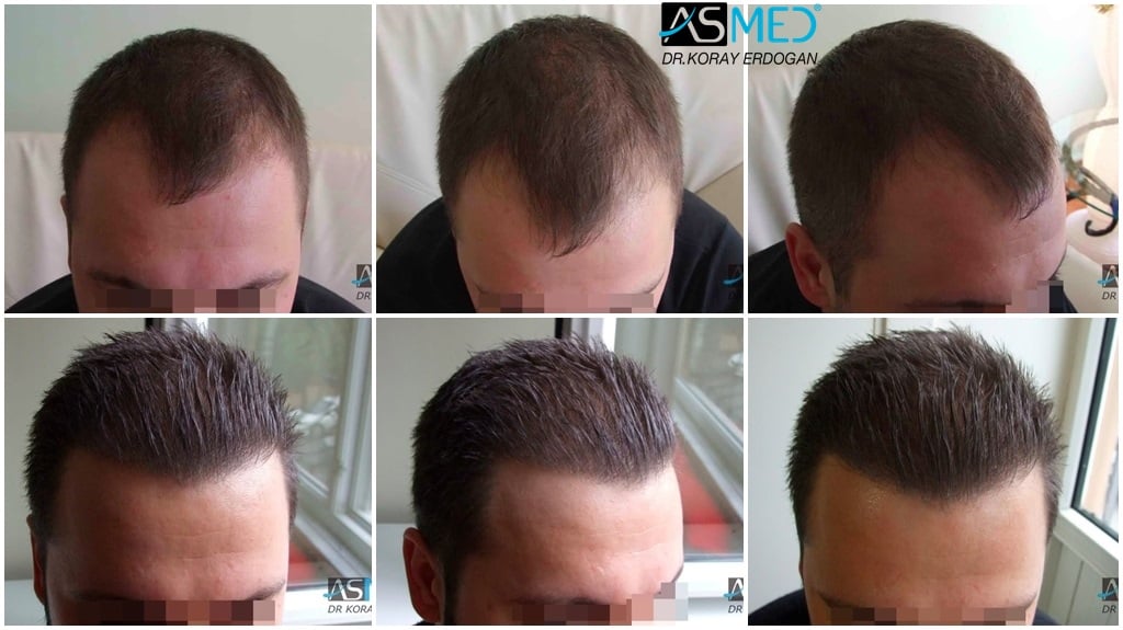 1800_Grafts_FUE gallery