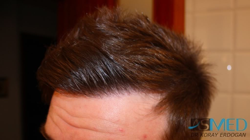 NORWOOD2 1950-grafts-FUE 0138f5fb
