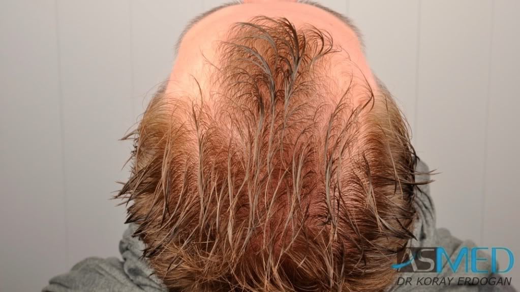 NORWOOD2 1950-grafts-FUE 04f65177