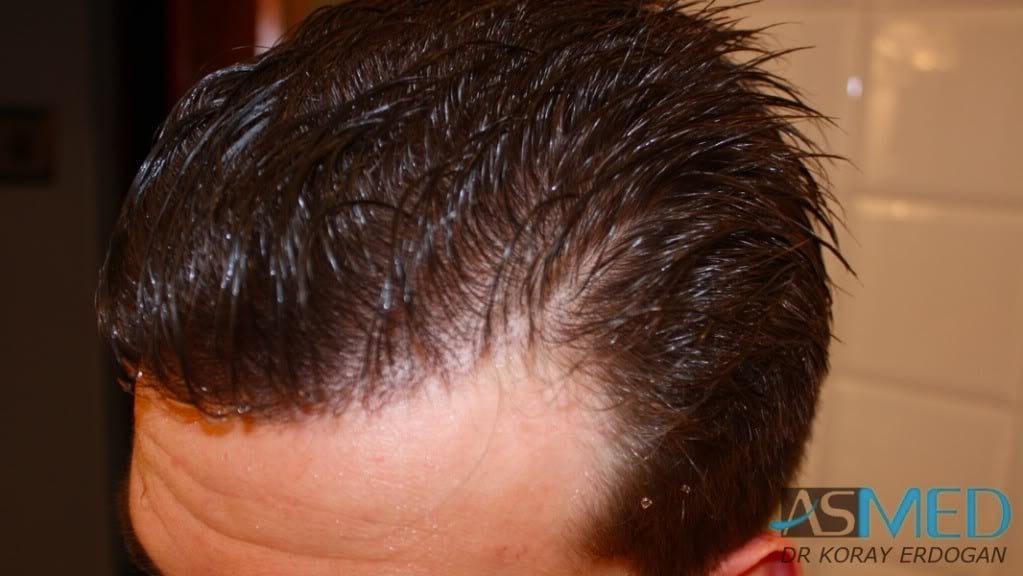 NORWOOD2 1950-grafts-FUE 0e4bc355