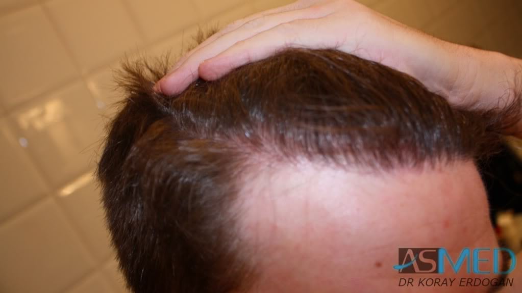 NORWOOD2 1950-grafts-FUE 15c4f5fe