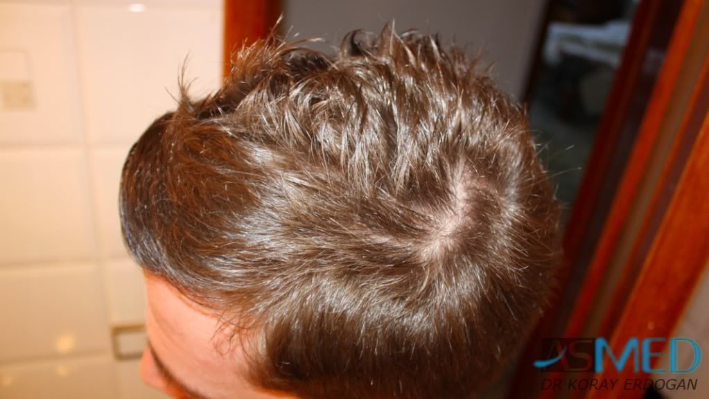 NORWOOD2 1950-grafts-FUE 1dc48ba4