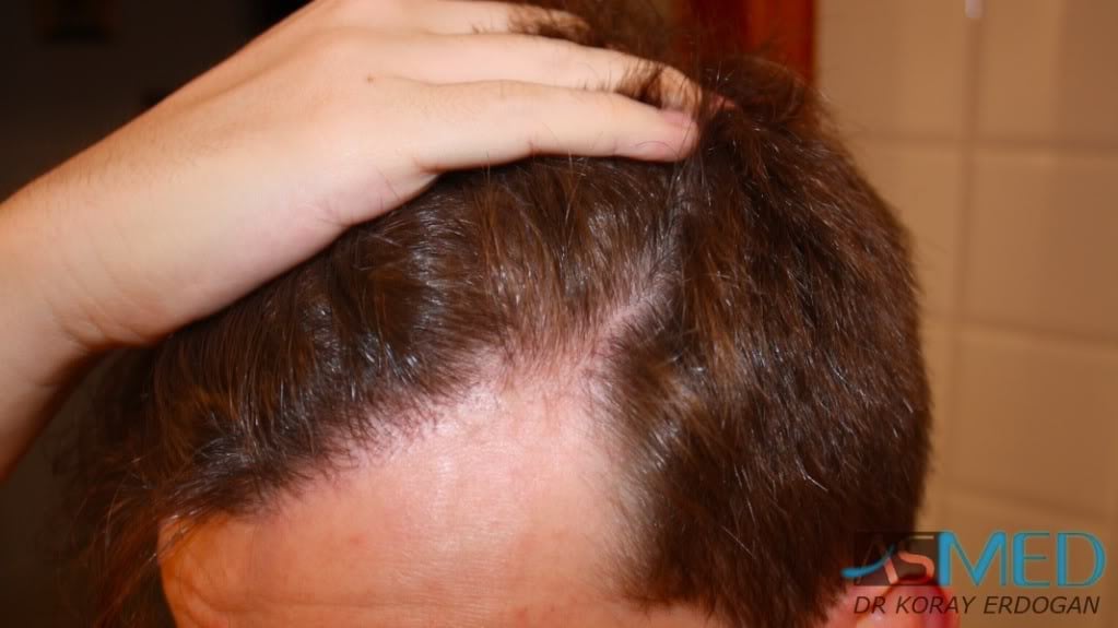 NORWOOD2 1950-grafts-FUE 3011b533