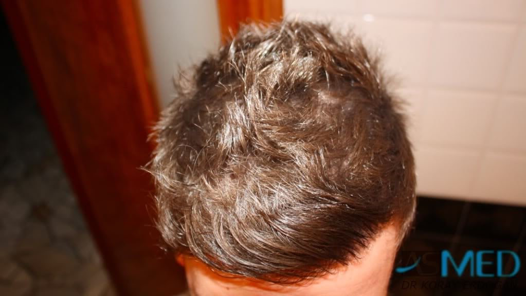 NORWOOD2 1950-grafts-FUE 35c380dd