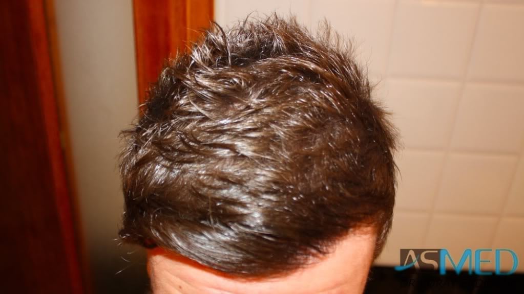 NORWOOD2 1950-grafts-FUE 40a62032