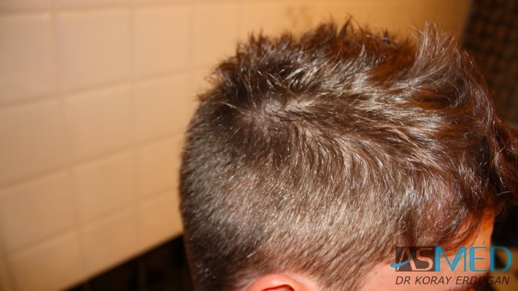 NORWOOD2 1950-grafts-FUE 42f4927f