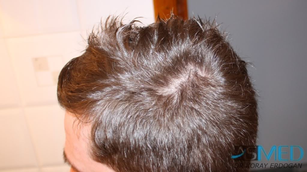 NORWOOD2 1950-grafts-FUE 43c14330