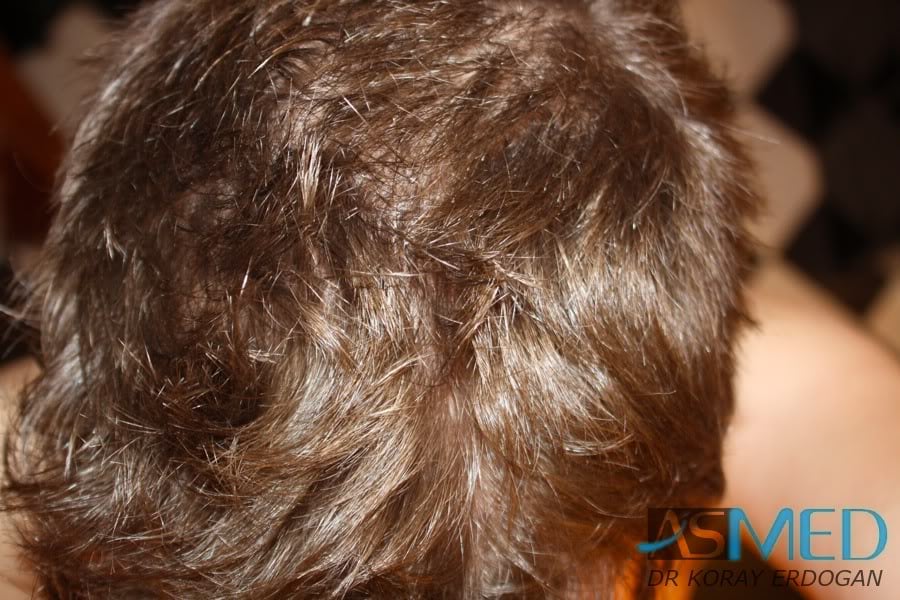 NORWOOD2 1950-grafts-FUE 4d33e817