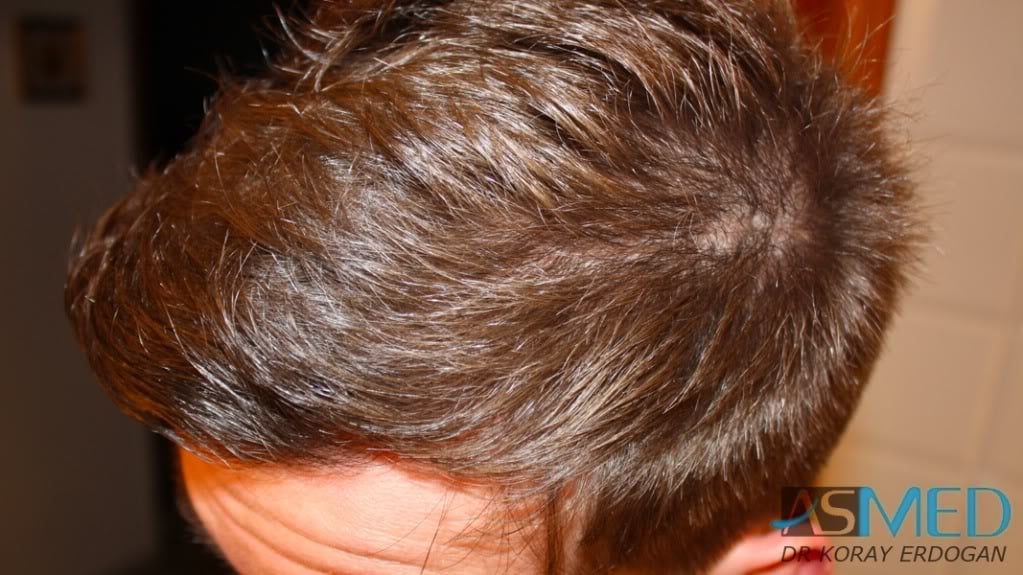 NORWOOD2 1950-grafts-FUE 8c1ae7db