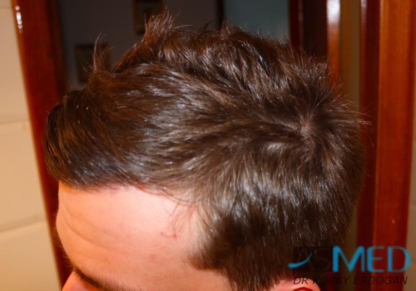 NORWOOD2 1950-grafts-FUE dcf8498d
