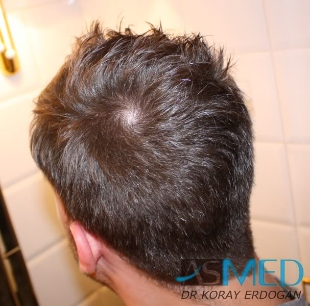 NORWOOD2 1950-grafts-FUE df24f8fc