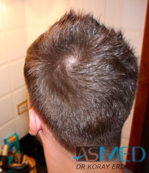 NORWOOD2 1950-grafts-FUE f4a0df62