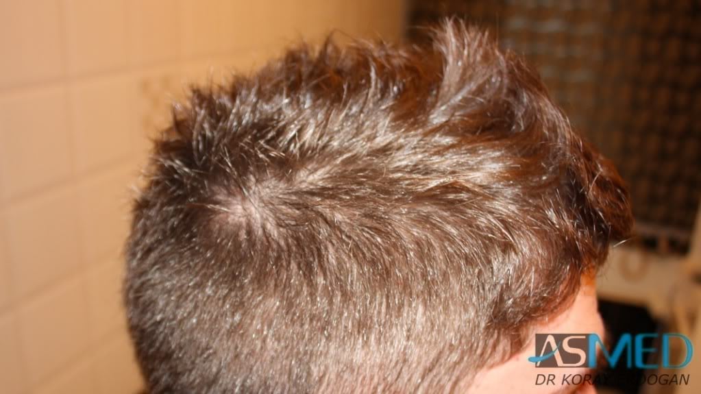 NORWOOD2 1950-grafts-FUE fc7ebfbc