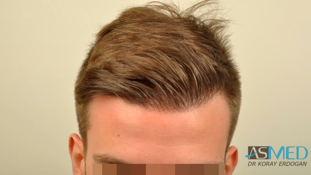 NORWOOD2 1950-grafts-FUE file-1