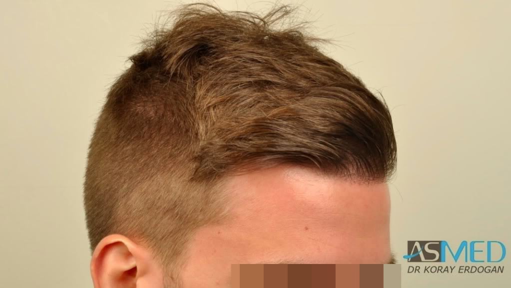 NORWOOD2 1950-grafts-FUE file-2