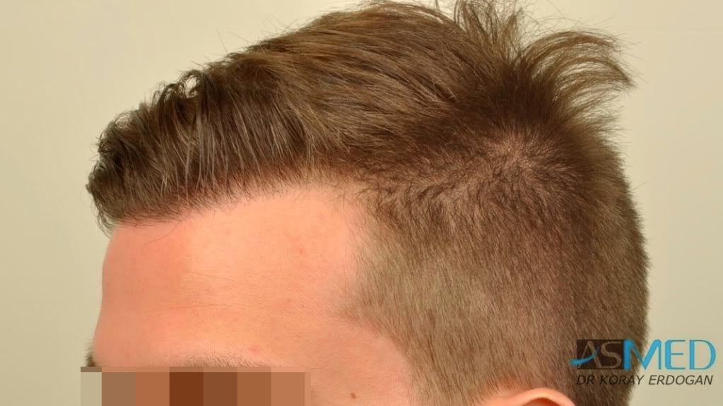 NORWOOD2 1950-grafts-FUE file-3
