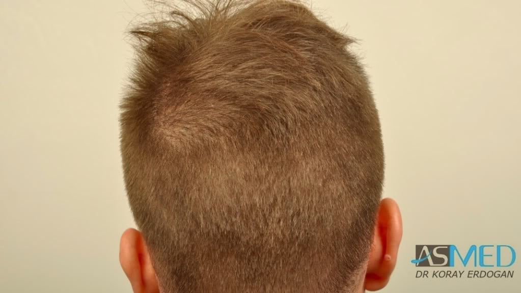 NORWOOD2 1950-grafts-FUE file-4