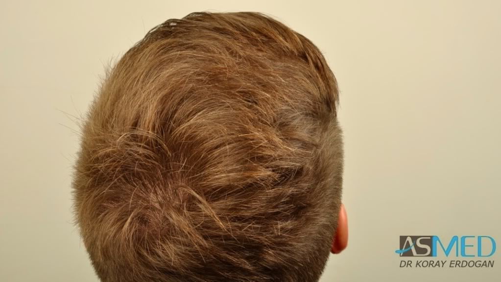 NORWOOD2 1950-grafts-FUE file-5