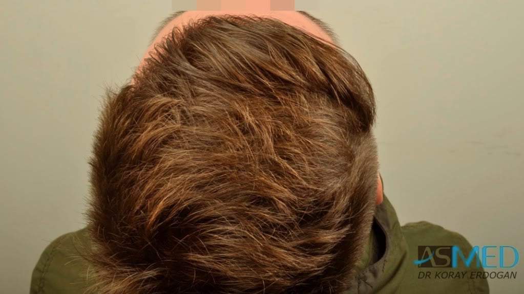 NORWOOD2 1950-grafts-FUE file-6