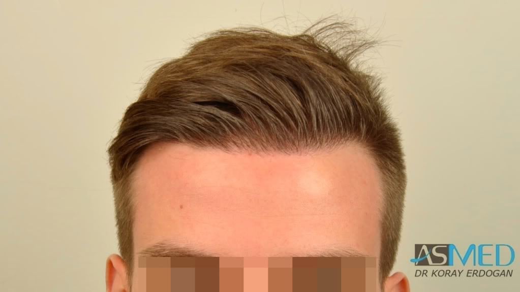 NORWOOD2 1950-grafts-FUE file