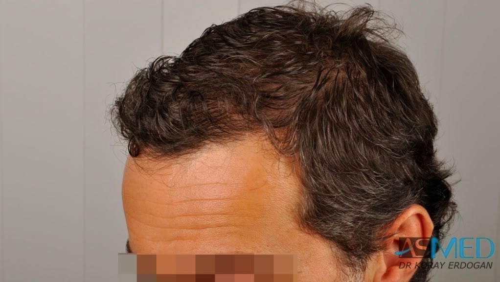 NORWOOD2 2000-grafts-FUE 33e8aab7