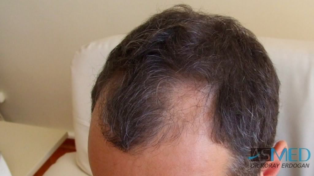 NORWOOD2 2000-grafts-FUE 5943256e