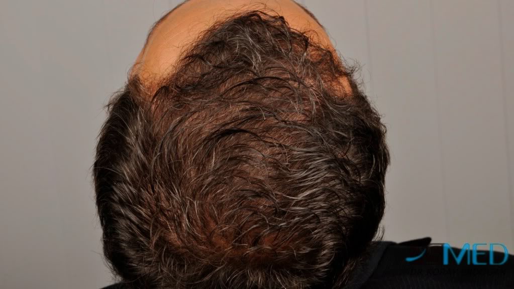 NORWOOD2 2000-grafts-FUE 7c5d224e