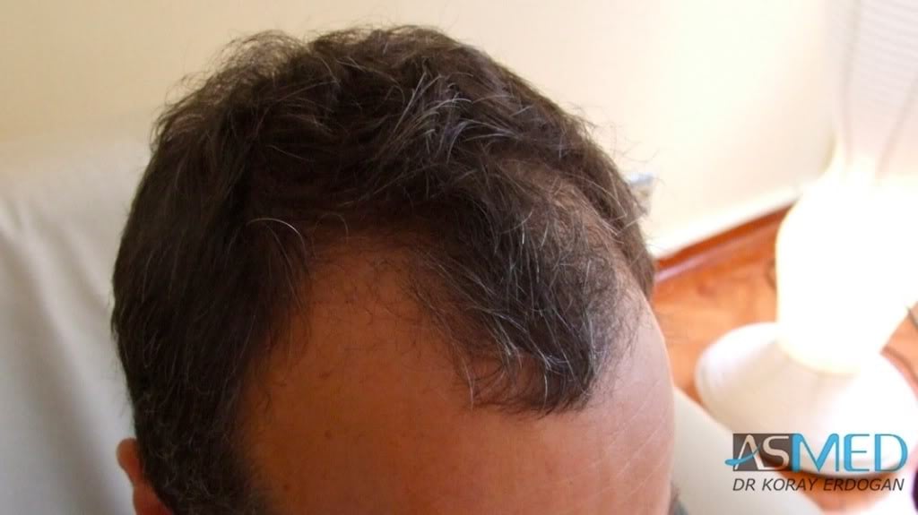 NORWOOD2 2000-grafts-FUE 9acaec24