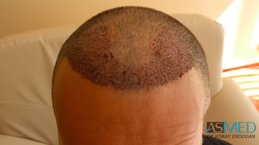 NORWOOD2 2000-grafts-FUE c54fcff1