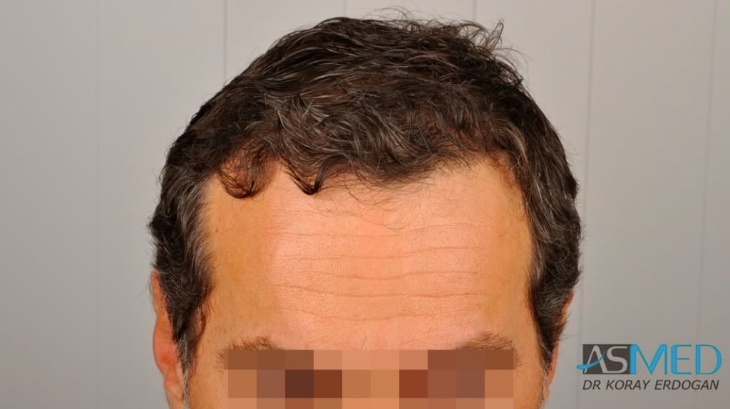 NORWOOD2 2000-grafts-FUE f4a6760c