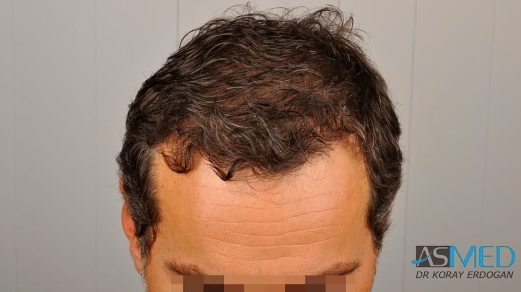 NORWOOD2 2000-grafts-FUE ffd1473e