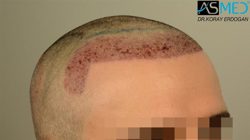 NORWOOD2 2203-grafts-FUE 10