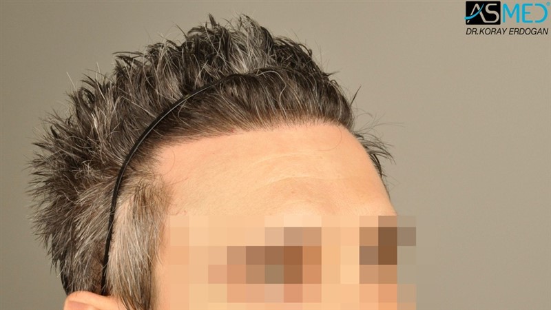 NORWOOD2 2203-grafts-FUE 11
