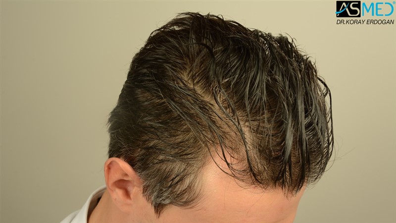 NORWOOD2 2203-grafts-FUE 12