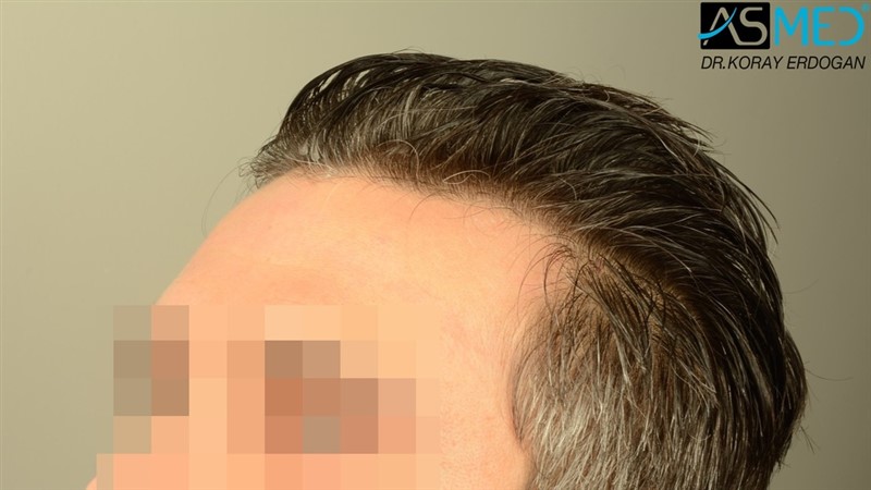 NORWOOD2 2203-grafts-FUE 15