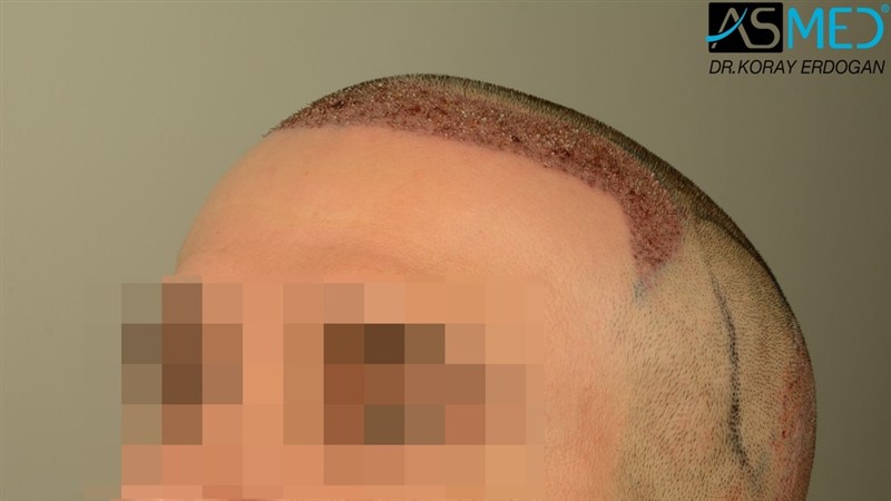 NORWOOD2 2203-grafts-FUE 16