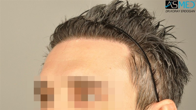 NORWOOD2 2203-grafts-FUE 17