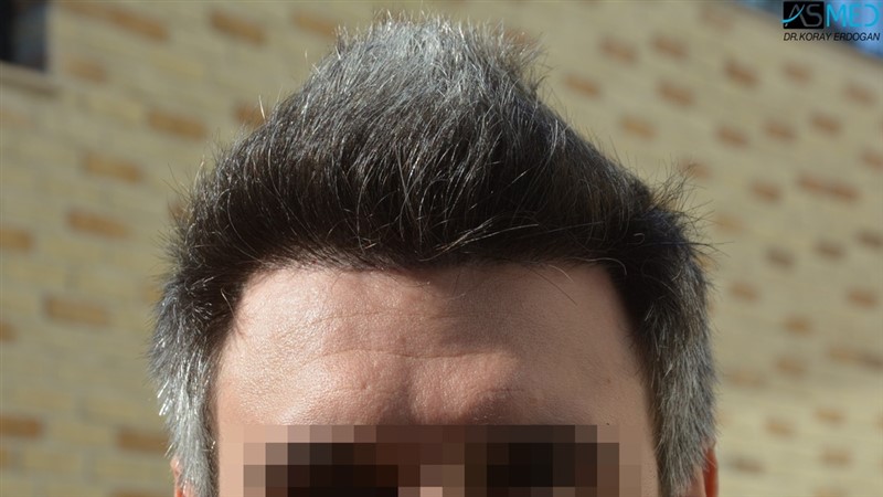 NORWOOD2 2203-grafts-FUE 2
