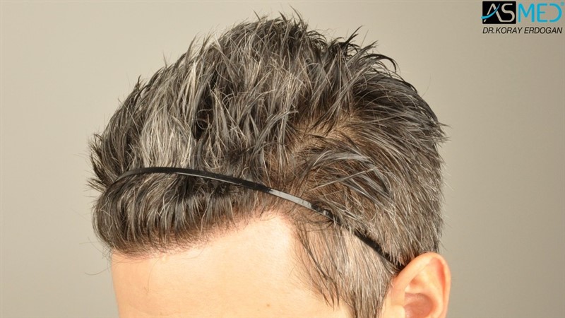 NORWOOD2 2203-grafts-FUE 20