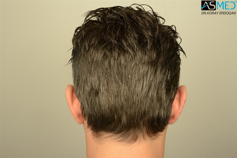 NORWOOD2 2203-grafts-FUE 24